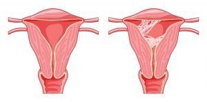 Sindrome di Asherman: aderenze dentro l’utero