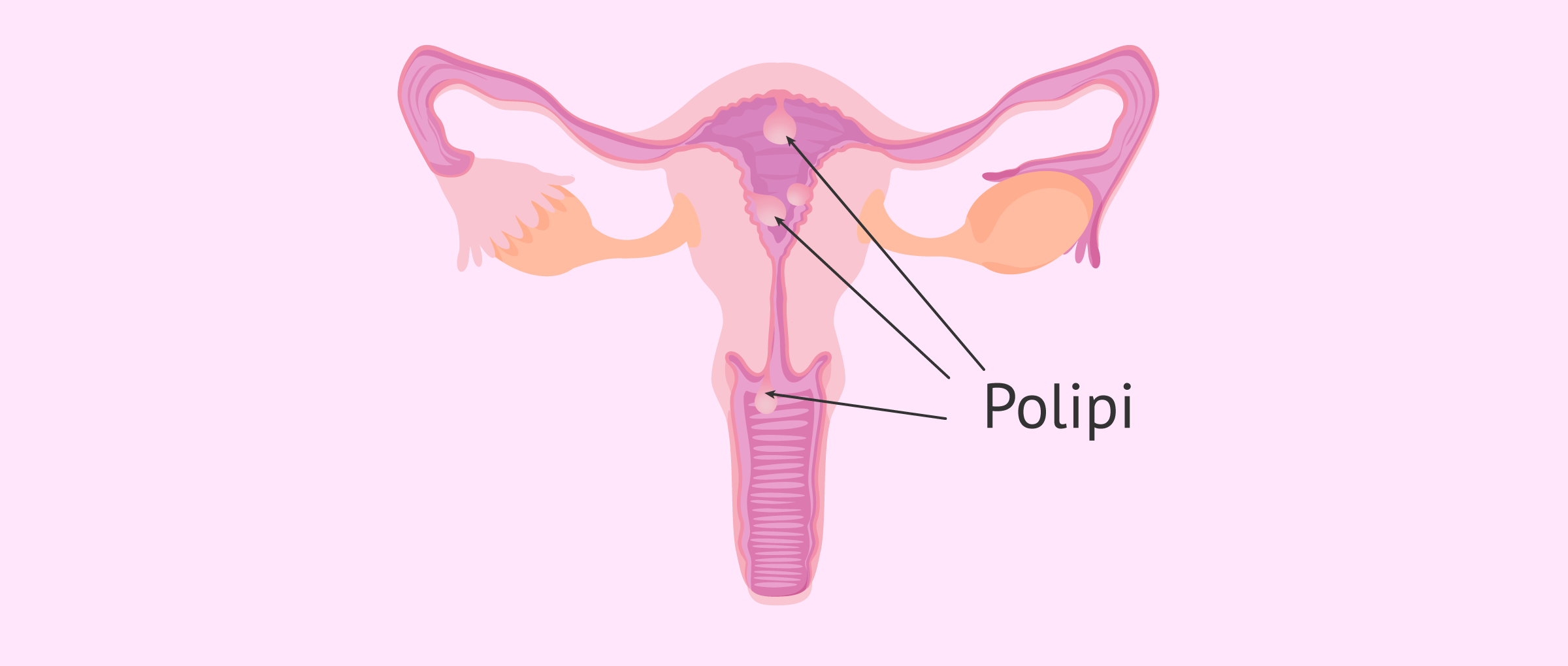 Polipi uterini: sintomi e quando intervenire