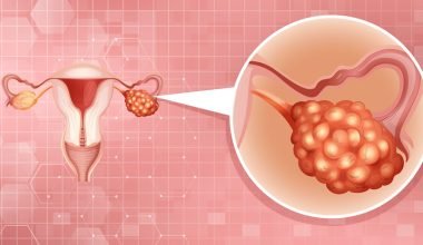 Resistenza ovarica: una diagnosi rara da approfondire
