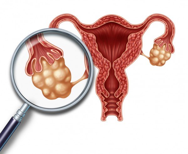 Sindrome MRKH: diagnosi e supporto specialistico
