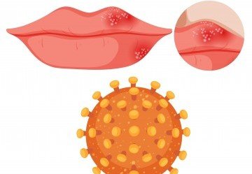 Herpes genitale: sintomi, terapia e prevenzione