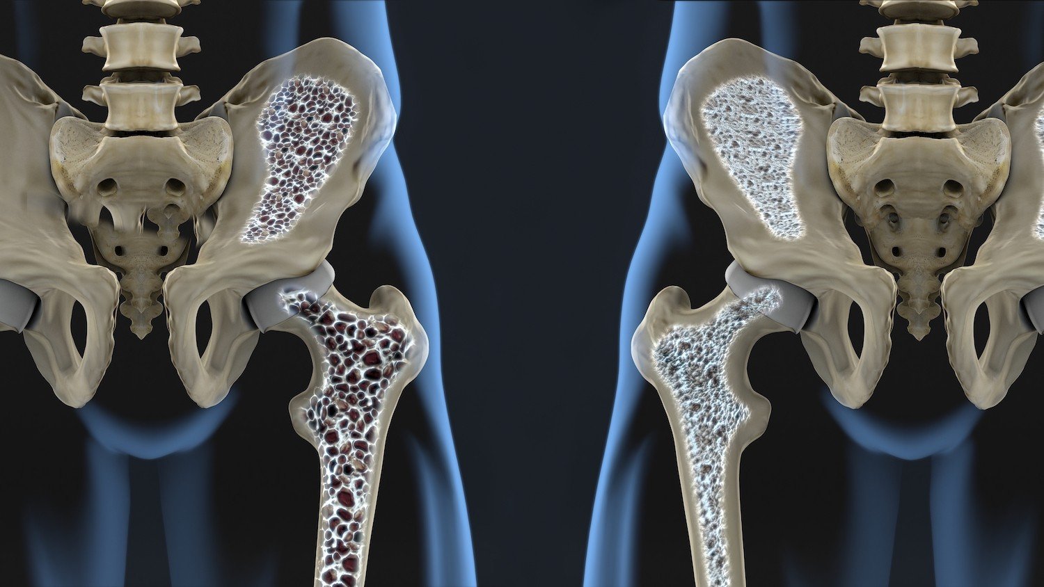 Osteoporosi dopo la menopausa: prevenzione e cure