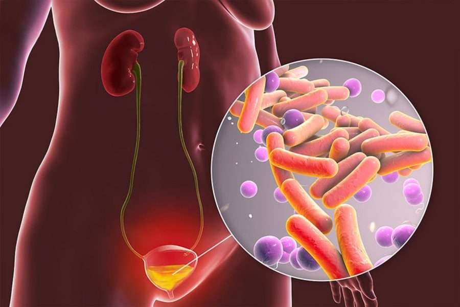 Uretrite nella donna: sintomi e diagnosi
