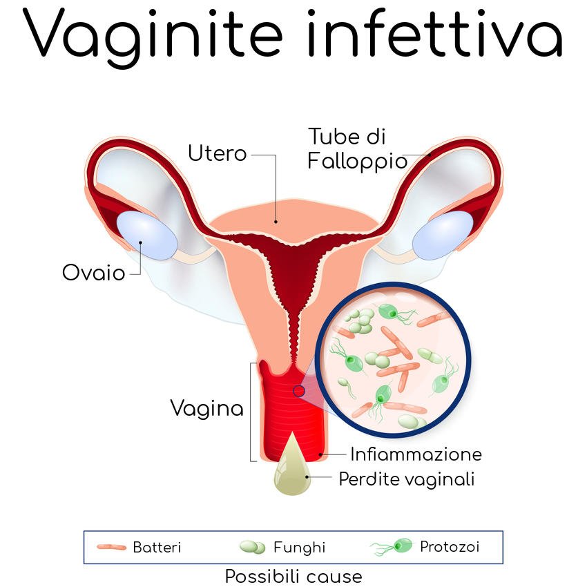 Disturbi vaginali: distinguere le diverse cause