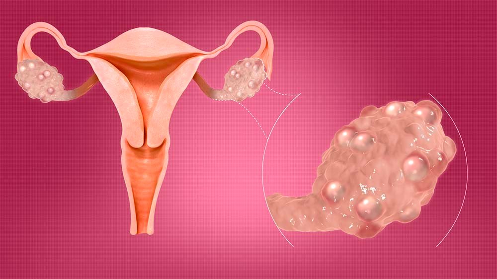 Ovaie aumentate di volume: cosa può significare