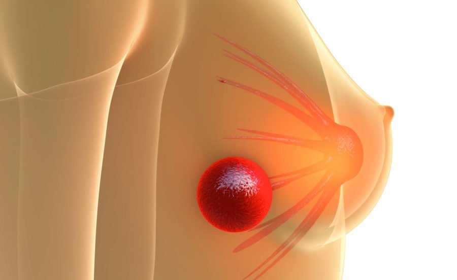 Dolore al seno: cause e quando consultare il medico