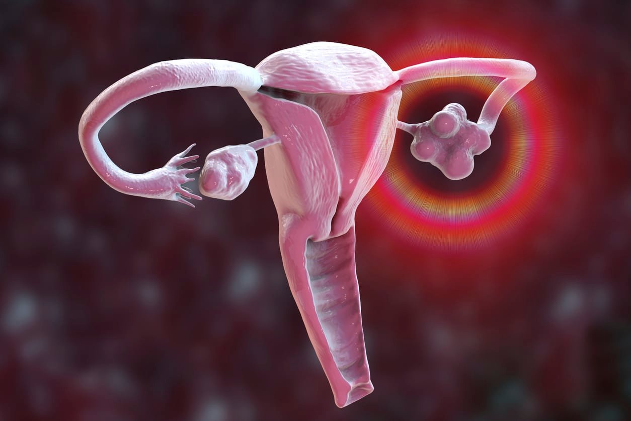 Dopo un intervento alle ovaie: funzione e fertilità