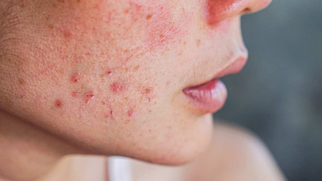 Acne Ormonale: Cause e Rimedi Ginecologici