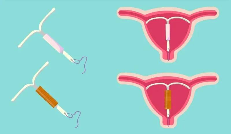 Contraccettivi intrauterini IUD vantaggi e rischi