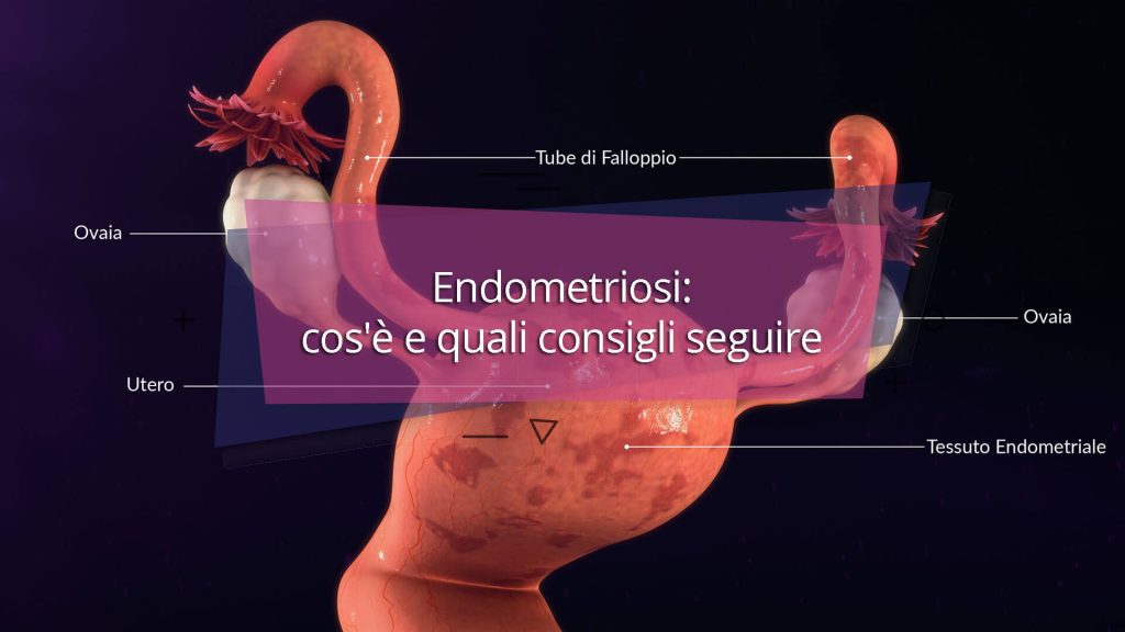 Endometriosi-cos-e-e-quali-consigli-seguire