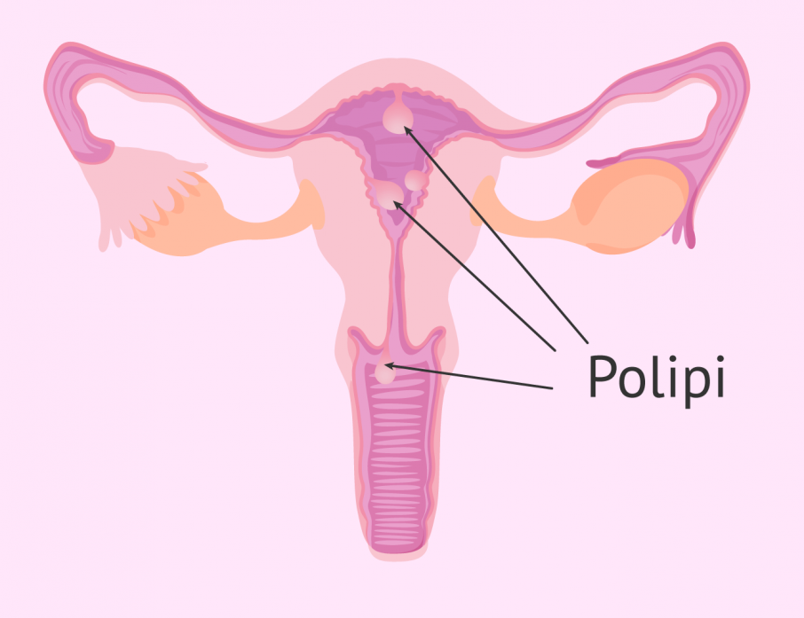 Polipi Uterini