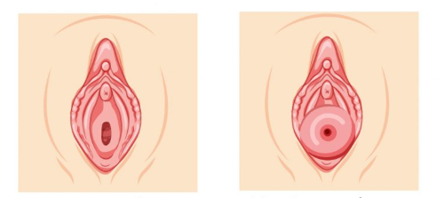 Prolasso Uterino