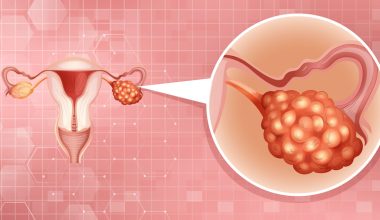 Sindrome da ovaio resistente, insufficienza ovarica precoce