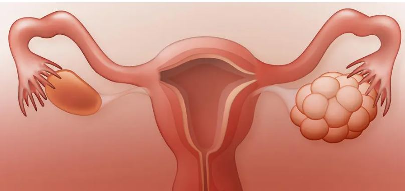 Sindrome dell’ovaio ipoattivo