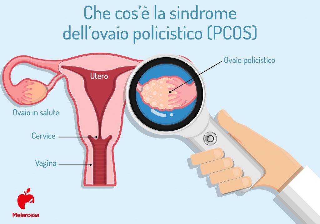 Sindrome dell'ovaio resistente alla stimolazione diagnosi e soluzioni