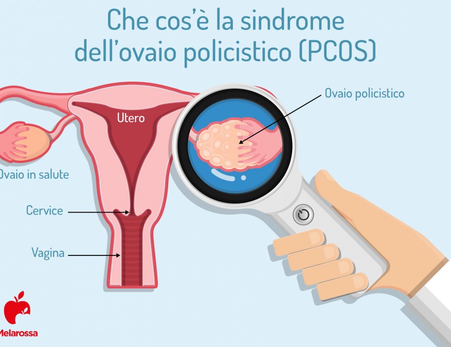 Sindrome dell'ovaio resistente alla stimolazione diagnosi e soluzioni