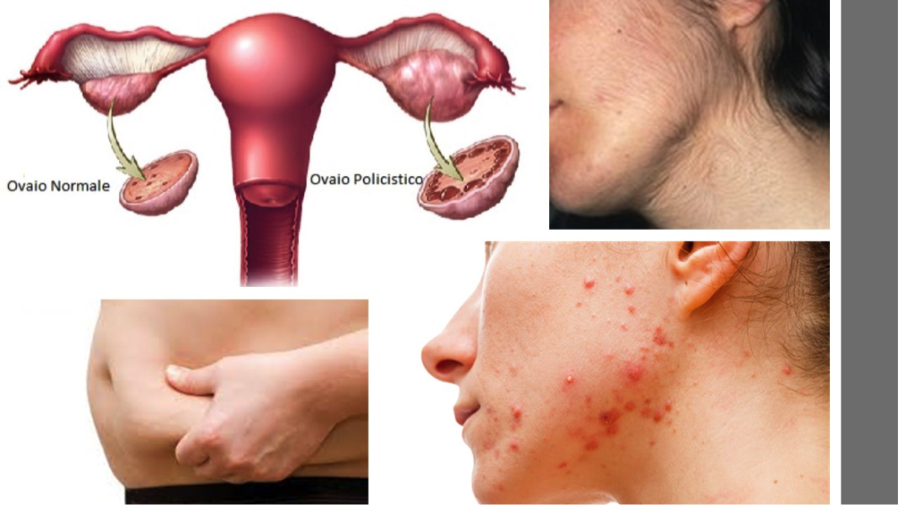 Sindrome dell’ovaio policistico: sintomi e trattamenti