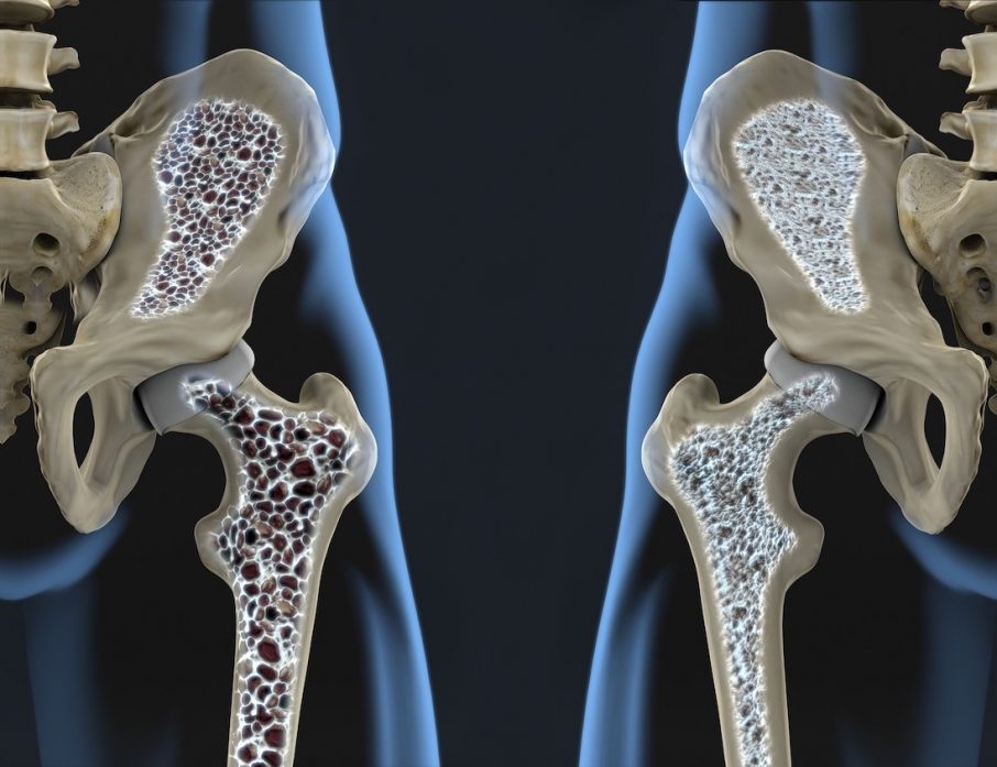 osteoporosi