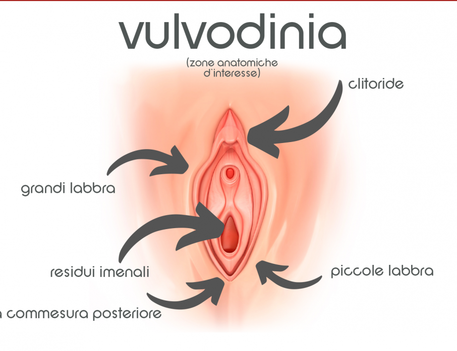vulvodinia sintomi diagnosi trattamenti