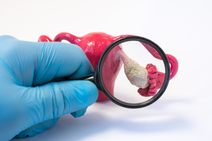 Carcinoma ovarico trattamenti avanzati