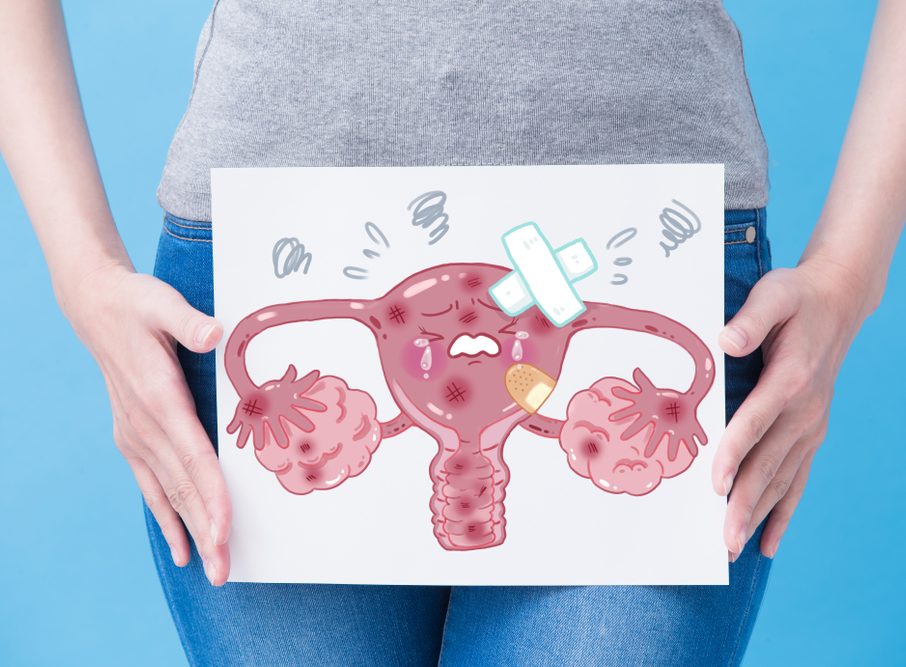 Ecografia ovaio multifollicolare vs PCOS