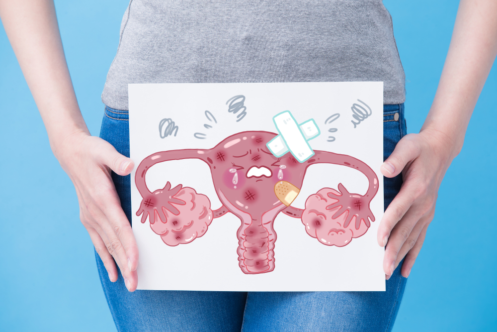 Ecografia ovaio multifollicolare vs PCOS