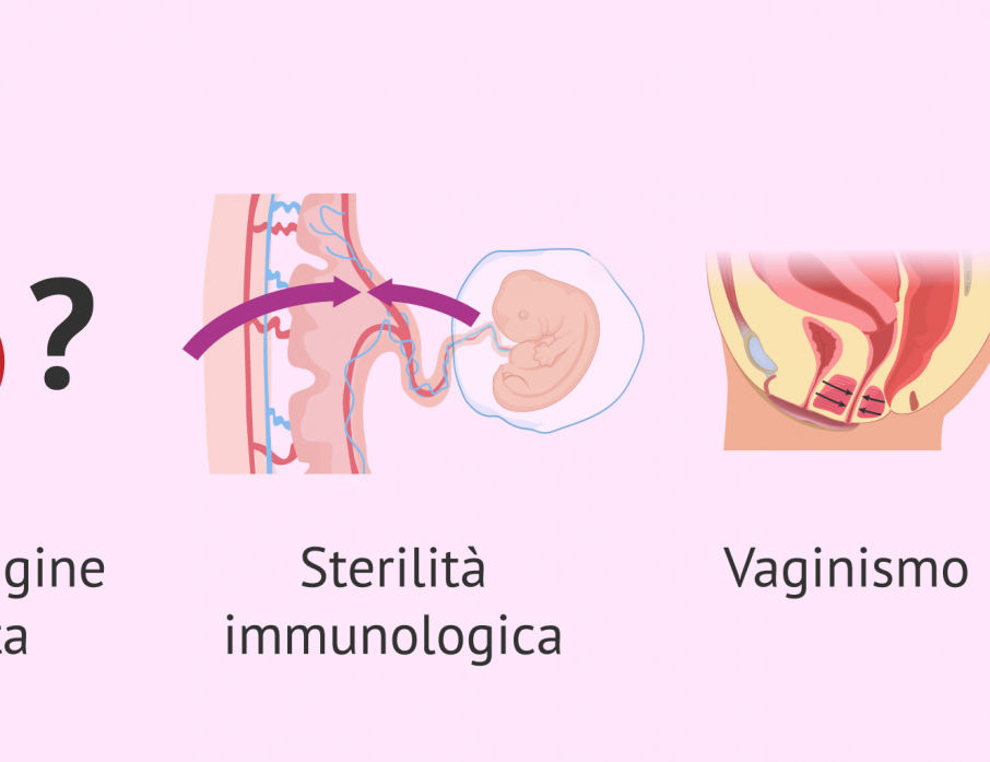 IBS fertilità donna ginecologia