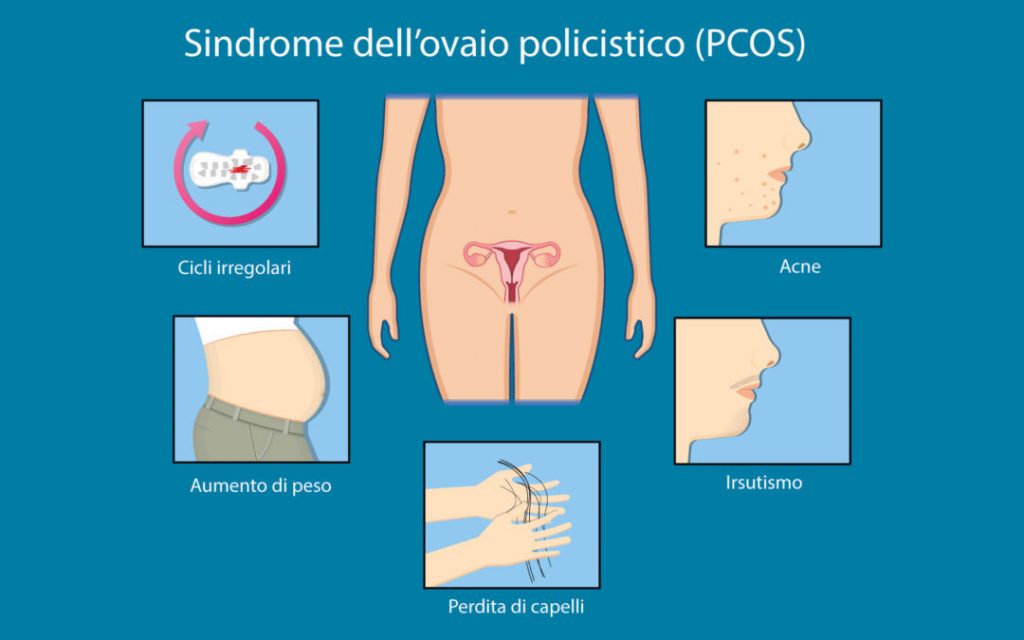 Sindrome dell’ovaio policistico (PCOS)