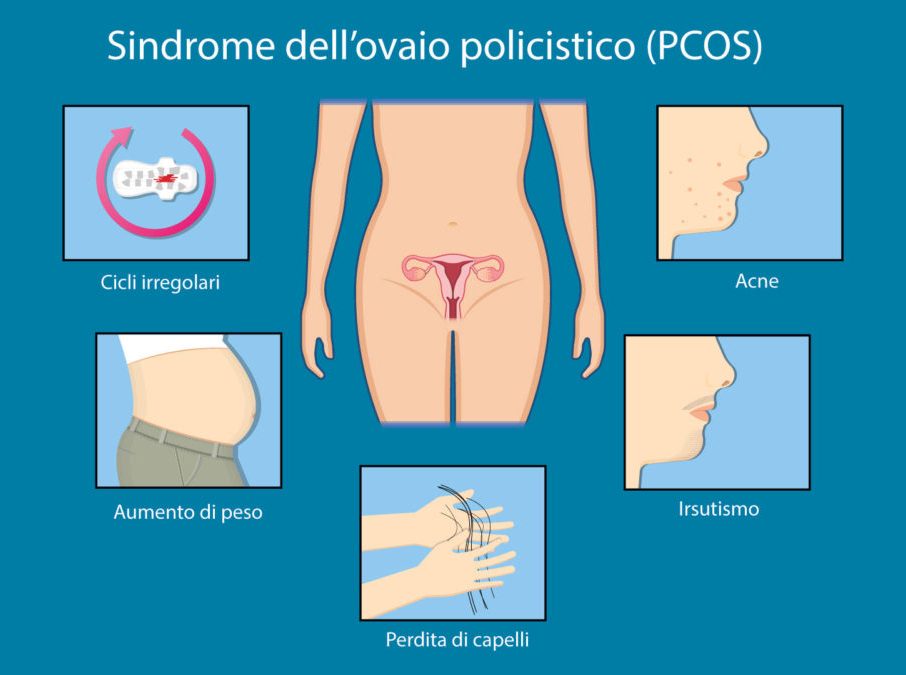 Sindrome dell’ovaio policistico (PCOS)