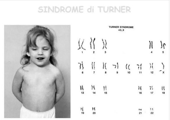 Sindrome di Turner ragazza salute benessere
