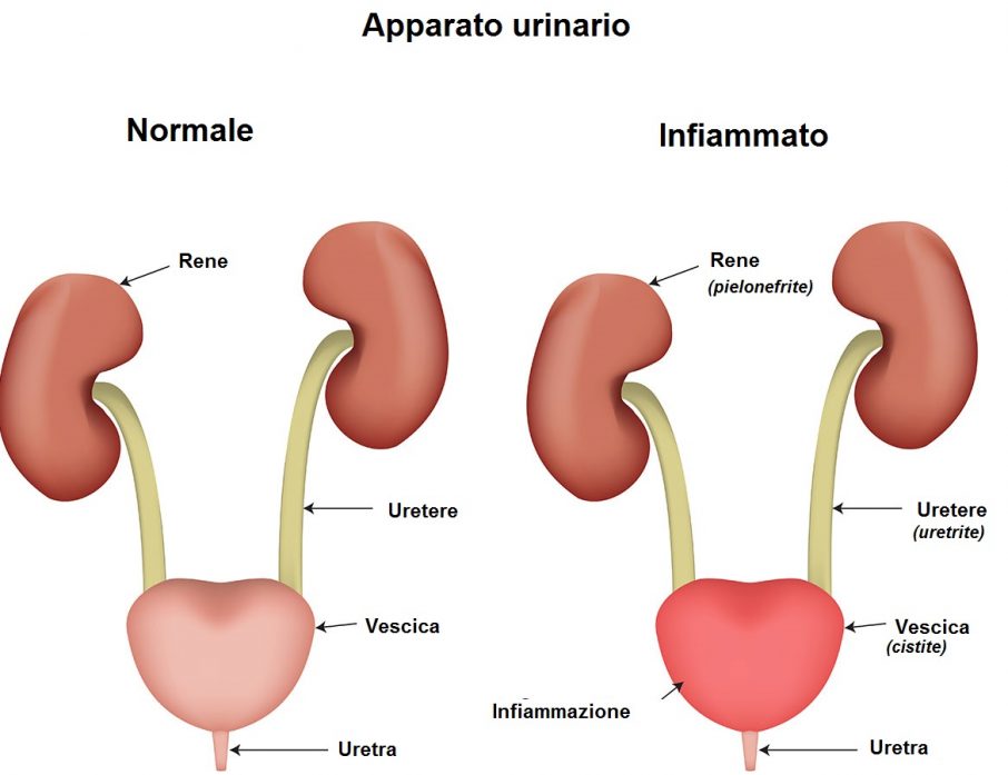 uretocistite sintomi e trattamento urinario