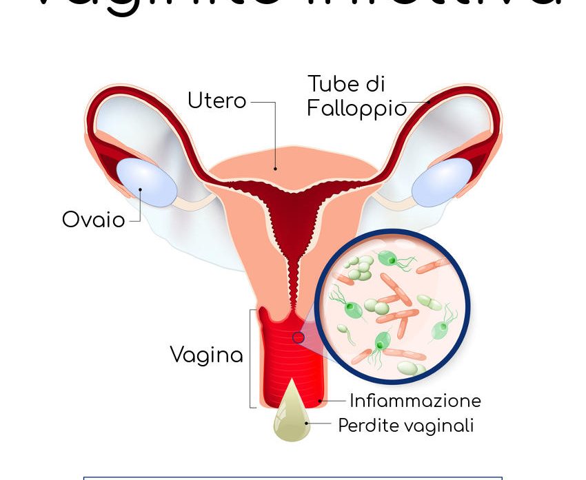 vaginite